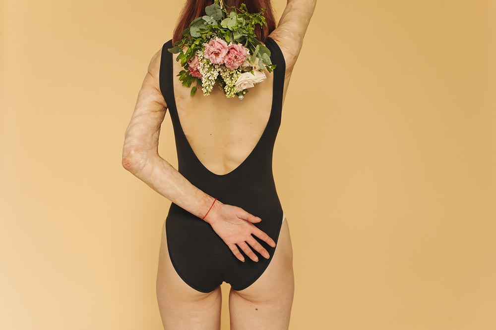 schöne schlanke Frau im Badeanzug steht mit dem Rücken zur Kamera und zeigt im Rahmen von Body Positivity ohne Scham ihre vernarbten Arme